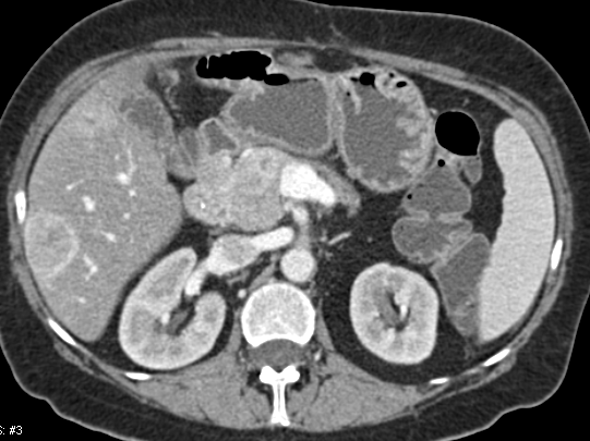 Centrally Necrotic Hyperenhancing Liver Lesion