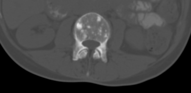 Calcified and Sclerotic Metastases
