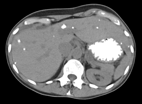 Calcified Liver Metastases